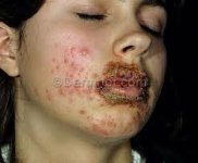 herpes.jpg