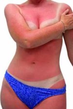 Sunburned_Woman.jpg